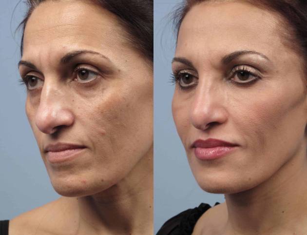 fractional-co2-before-and-after-gallery-patient-photo-21